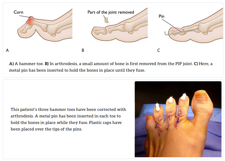 Claw Hammertoes Treatment In Pune Dr Chetan Oswal