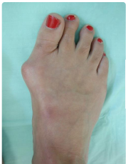 Foot Bunion Treatment In Pune Dr Chetan Oswal