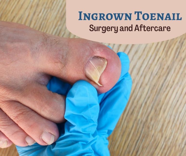 Ingrown Toenail Surgery And Aftercare Dr Chetan Oswal Pune