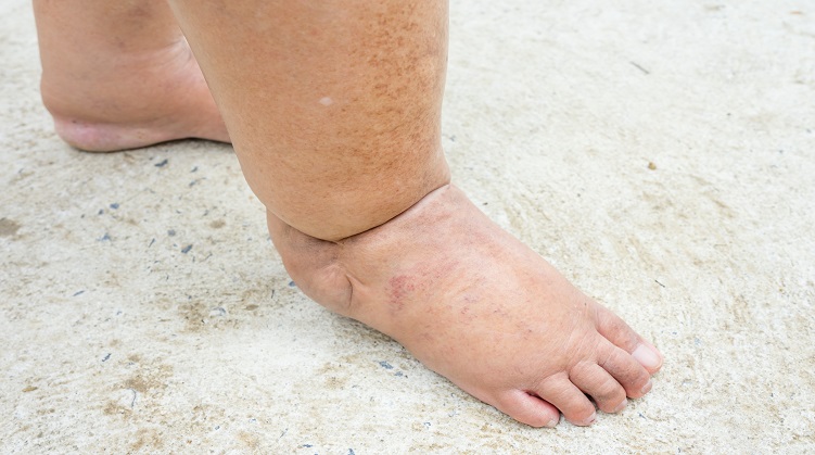 Ingrown Toenails: Signs, Causes, Treatment & Prevention