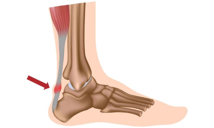 Achilles Tendinopathy Treatment in Pune Pimpri Chinchwad PCMC | Orthowin Foot & Ankle Clinic | Dr. Chetan Oswal