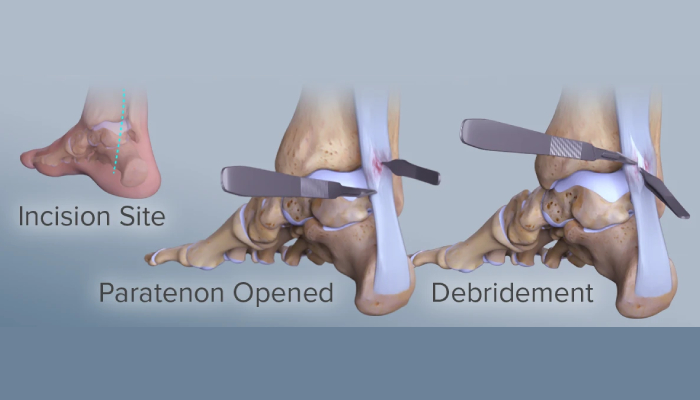 Achilles Tendon Repair Surgery & Treatment Pune, Pimpri Chinchwad | Dr. Chetan Oswal | Orthowin Foot & Ankle Clinic