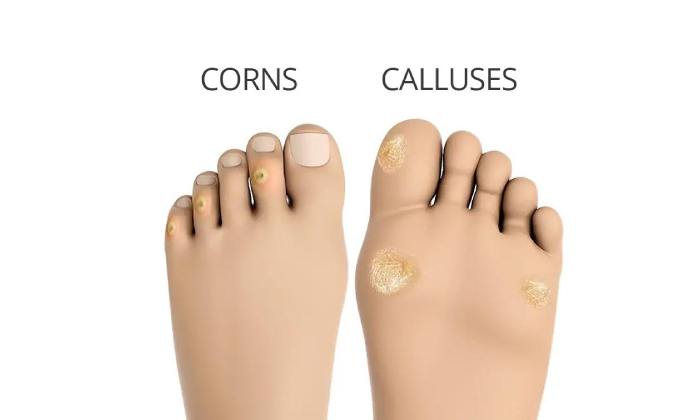 Corns & Calluses Treatment in Pune, Pimpri Chinchwad PCMC | Orthowin Foot & Ankle Clinic | Dr. Chetan Oswal