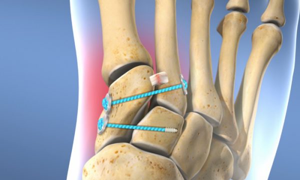 Lisfranc (Midfoot) Fracture Treatment in Pune | Dr. Chetan Oswal