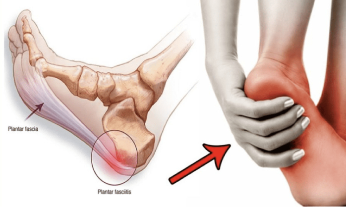 Home Exercises Program for Plantar Fasciitis — Integrative Health