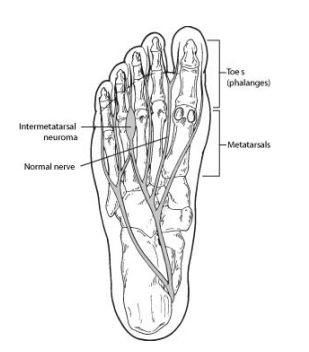 Morton s Neuroma Treatment in Pune Dr. Chetan Oswal