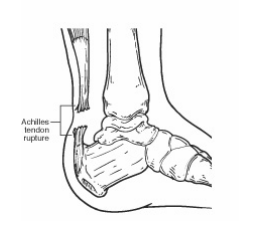 If you feel sudden pain in the back of the ankle or difficulty in walking. Diagnose & get treatment for Achilles tendon rupture from the best foot & ankle surgeon Dr. Chetan Oswal 