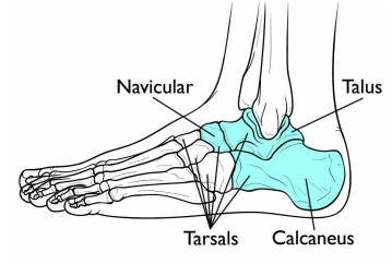 Tarsal Coalition Treatment Pune | Dr. Chetan Oswal