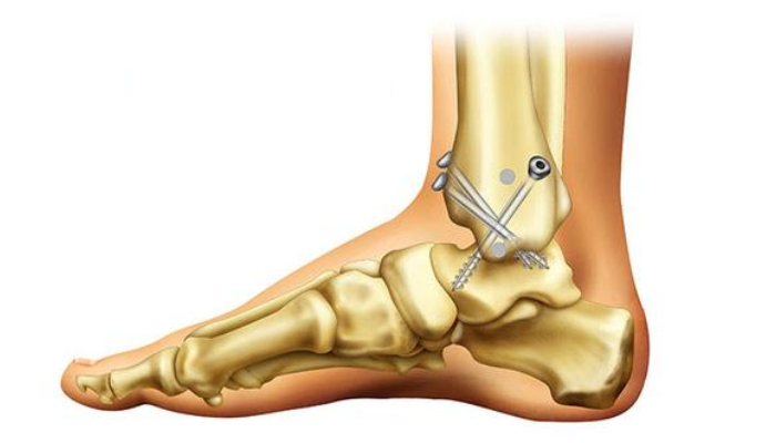 Arthroscopic Ankle Fusion Surgery & Treatment Pune | Dr. Chetan Oswal | Orthowin Clinic