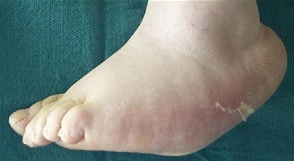 Charcot Foot Treatment in Pune Dr. Chetan Oswal