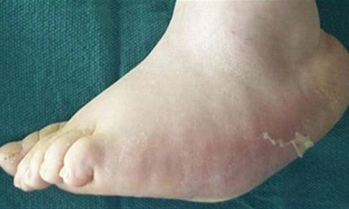 Charcot Foot Treatment in Pune, Pimpri Chinchwad PCMC | Orthowin Foot & Ankle Clinic | Dr. Chetan Oswal