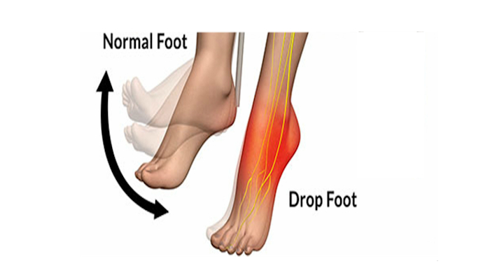 Foot Drop Surgery Pune Foot Ankle