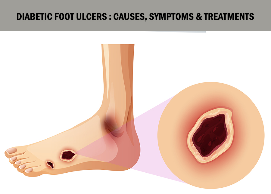 Diabetic Foot Ulcers Treatment Pune, Pimpri Chinchwad PCMC