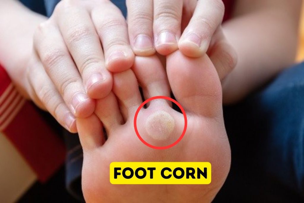 foot corn treatment