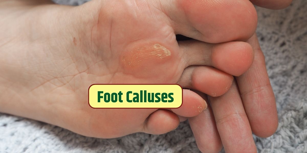 Causes of Foot Calluses