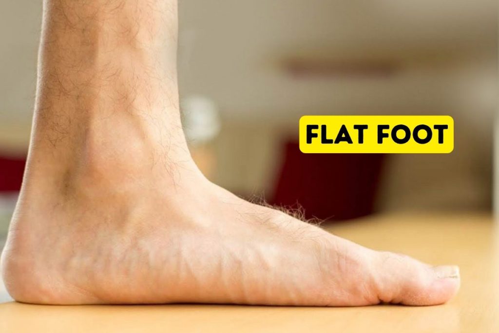 flat foot treatment