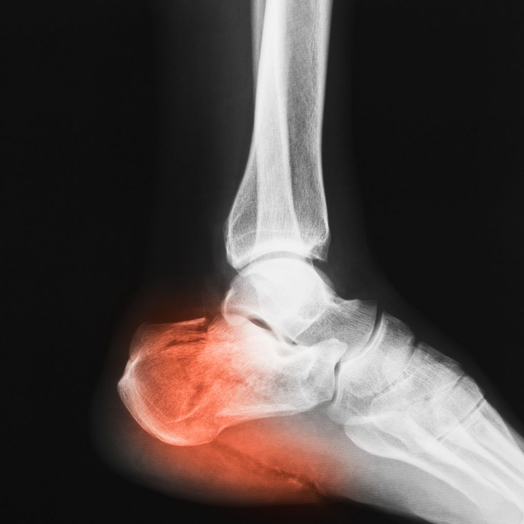 A) Lateral X-ray of calcaneus, obvious displacement of calcaneal... |  Download Scientific Diagram