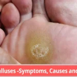 Treatment for corns and calluses in Pune