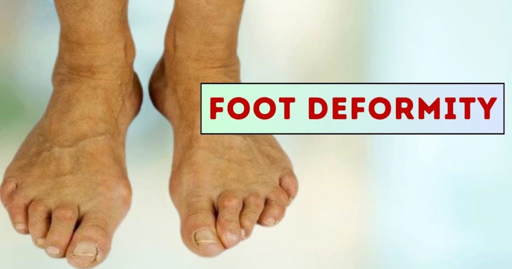 foot deformity treatment in pune