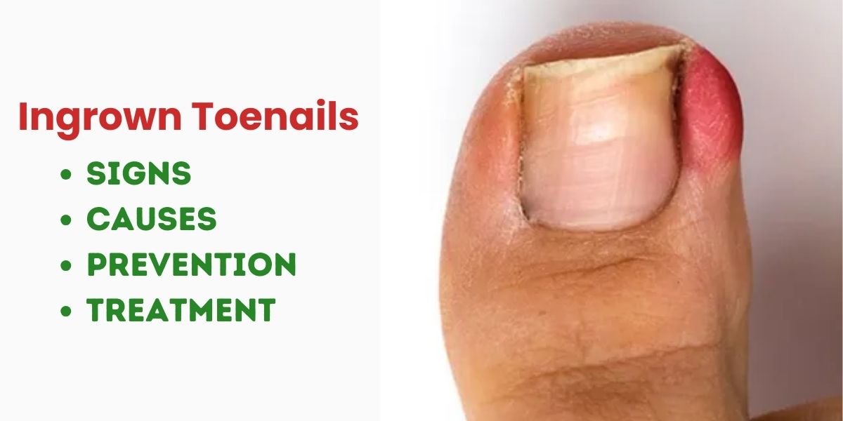 Ingrown Toenails - signs, causes and treatment
