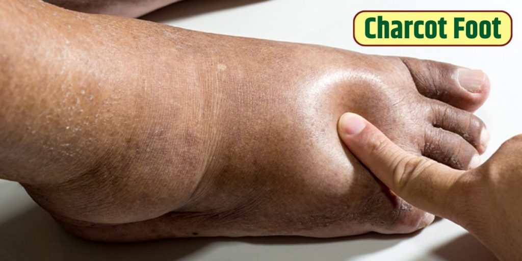 charcot foot