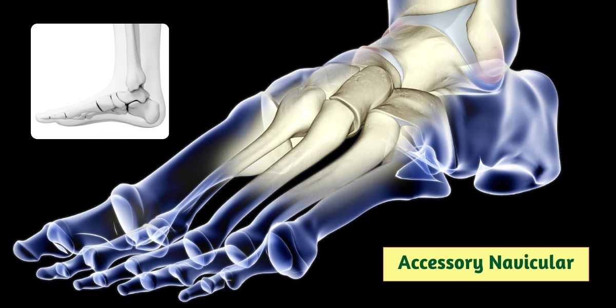 Accessory Navicular - Symptoms causes and treatment options