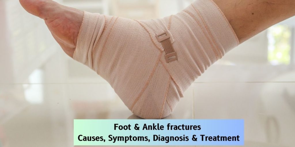 Foot & Ankle fractures – Causes, Symptoms, Diagnosis & Treatment