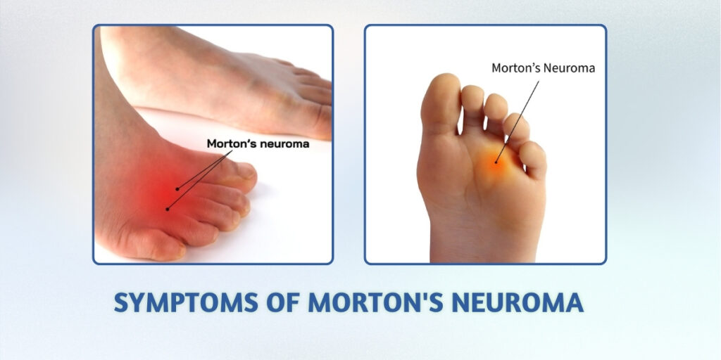 Morton's Neuroma