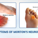 Morton's Neuroma