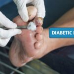 how to manage diabetic foot ulcers