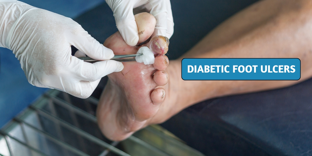 how to manage diabetic foot ulcers