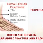 Difference Between Trimalleolar Ankle Fractures and Pilon Fractures