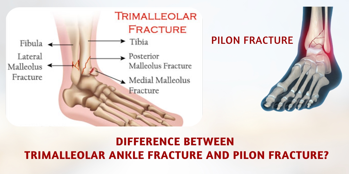 Difference Between Trimalleolar Ankle Fractures and Pilon Fractures